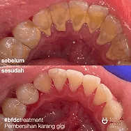 before-after dental cleaning