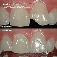 before-after tooth white filling 2