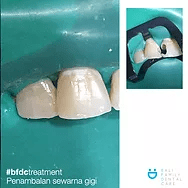 before-after tooth white filling 4