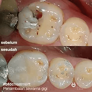 before-after tooth white filling 6