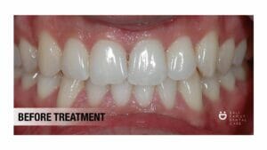 porcelain veneer; dentist in bali