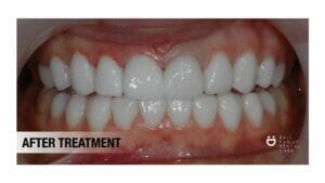 porcelain veneer; dentist in bali