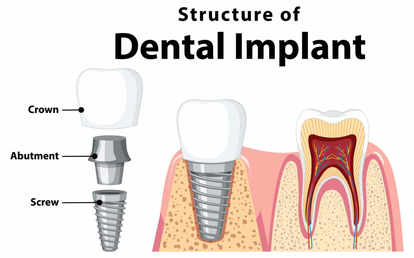 Dental implant bali packages, what to know about? - Bali Family Dental Care