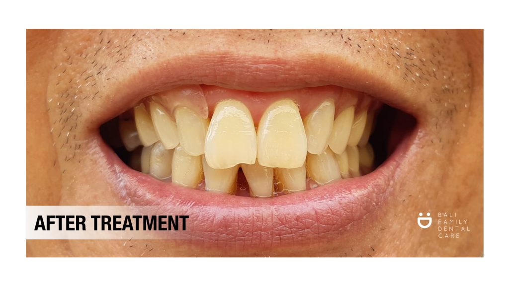 Dentures in Bali treatment