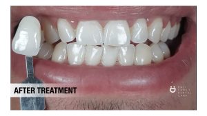 teeth whitening ; whitening ; dental bleaching ; bleaching ; teeth whitening in bali ;