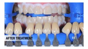 teeth whitening ; whitening ; dental bleaching ; bleaching ; teeth whitening in bali ;