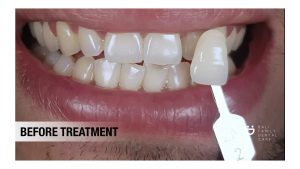 teeth whitening ; whitening ; dental bleaching ; bleaching ; teeth whitening in bali ;