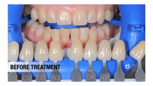 teeth whitening ; whitening ; dental bleaching ; bleaching ; teeth whitening in bali ;